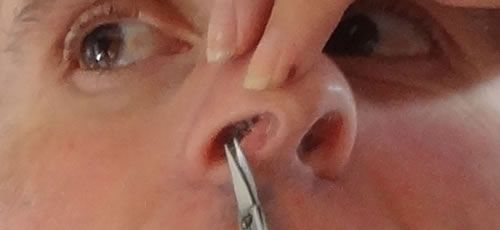 Epilation des poils du nez