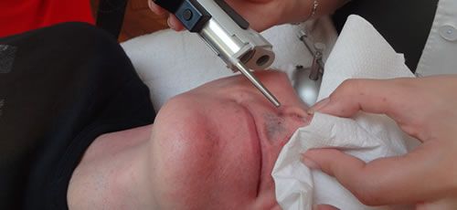 Epilation des poils du nez - laser