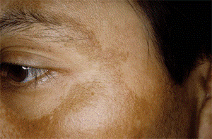 melasma